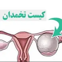 کیست تخمدان؛ مشکل شایع اما اغلب بی‌خطر در زنان