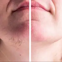 برای از بین بردن موهای زائد روی بدن چه کاری باید انجام بدهیم؟