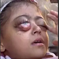 اسرائیل هم کودکیش را دزدید هم چشمانش را !