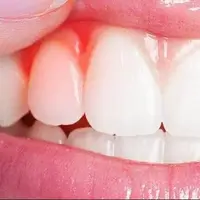 کیفیت خواب ضعیف، رهاورد بیماریهای لثه