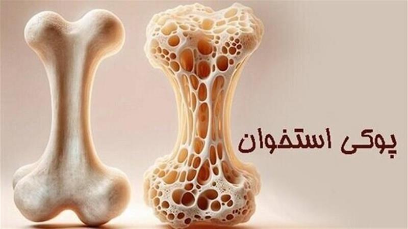 پوکی استخوان؛ تشخیص و درمان به موقع