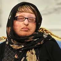 تلاش ۱۴ ساله آمنه بهرامی برای دریافت دیه چشمانش