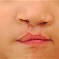 جراحی رایگان شکاف لب در یزد