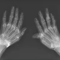 کشف صدها رشته طلای خالص در زانوی زن مبتلا به آرتروز