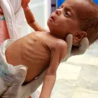 سوءتغذیه، همچنان از دردهای غزه