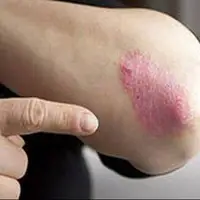از بیماری «پسوریازیس» چه می دانید