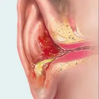 پیاز درمانی؟ ضد عفونت گوش!