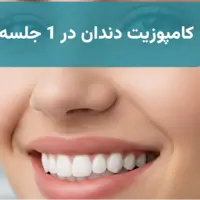 کامپوزیت دندان در 1 جلسه + وام ۳۰۰ میلیونی (خبر خوب برای تهرانیها)