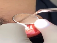 لحظه خارج کردن عنکبوت زنده از گوش خانم باردار بعد از پنج روز