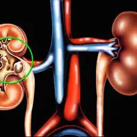 خبر خوب برای افرادی که دچار عارضه سنگ کلیه هستند!