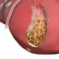 مهم‌ترین عامل سنگ کیسه صفرا غذاهای چرب است