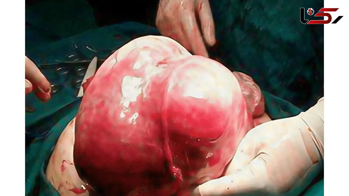 توده 7 کیلویی از رحم یک بیمار در اردبیل خارج شد