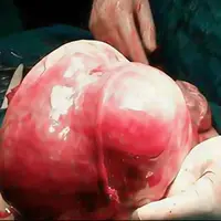 توده 7 کیلویی از رحم یک بیمار در اردبیل خارج شد