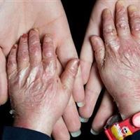 ۹۵ درصد بیماران «ای بی» حاصل ازدواج فامیلی/ امکان تشخیص پیش از تولد وجود ندارد