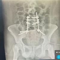 جراحی موفق اتصال مجدد ستون فقرات به لگن در پارسآباد