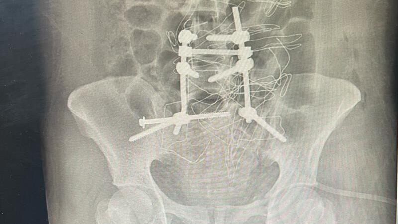 جراحی موفق اتصال مجدد ستون فقرات به لگن در پارسآباد
