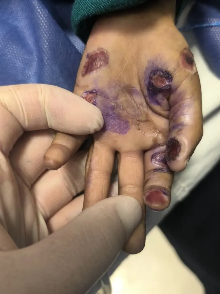 بچه ۴ ساله هرمزگانی قربانی کودکآزاری شد