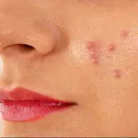 ماسک خانگی برای درمان جوش