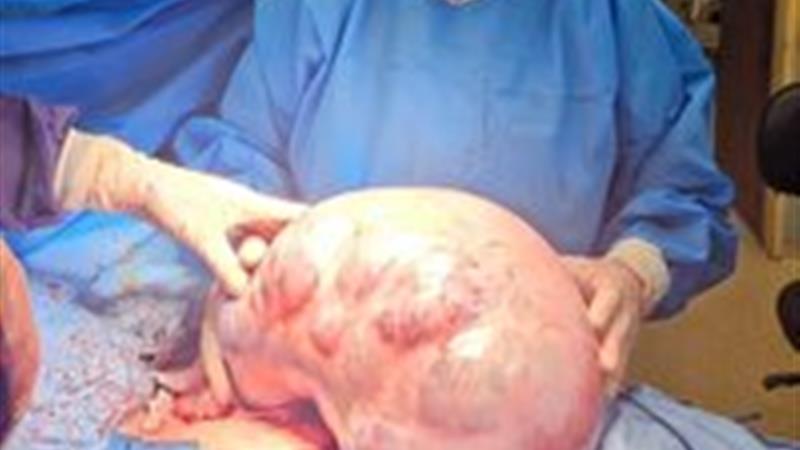 خارج کردن توده ۱۰ کیلویی از شکم بیمار در کرج