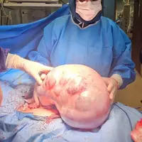 خارج کردن توده ۱۰ کیلویی از شکم بیمار