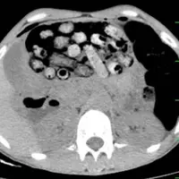 خروج ۹۰ بسته مواد مخدر از معده و روده یک بیمار