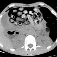 خروج ۹۰ بسته مواد مخدر از معده و روده یک بیمار در کرج