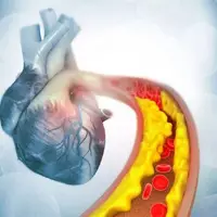 کاهش چربی خون با کمک ویرایش ژن برای اولین بار