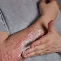 عواملی که باعث اگزما پوستی می‌شود، چیست؟