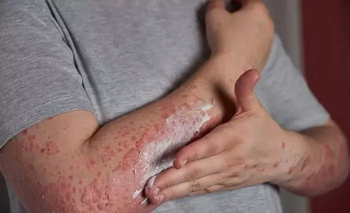 عواملی که باعث اگزما پوستی می‌شود، چیست؟