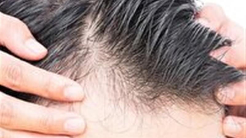روش های درمان ریزش موی شقیقهها