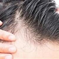 روش های درمان ریزش موی شقیقه‌ها