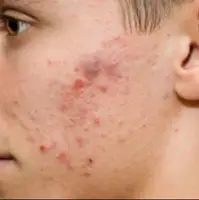 ۴ راهکار برای مقابله با آکنه در سرما