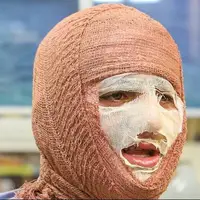 سوختگی؛ آسیب جسمی و روانی که فراتر از درمان است