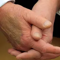 ترامپ در تلاش برای پنهان کردن کبودی مزمن دست راست