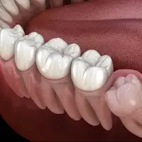 بیماری لثه خطر سکته مغزی را افزایش می دهد