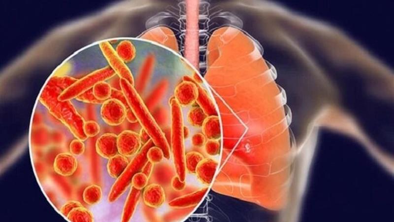 پنومونی؛ همچنان بزرگترین قاتل عفونی جهان / ضرورت تقویت واکسیناسیون جهت مهار مرگومیر ذاتالریه