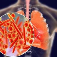 پنومونی؛ همچنان بزرگترین قاتل عفونی جهان / ضرورت تقویت واکسیناسیون جهت مهار مرگومیر ذاتالریه