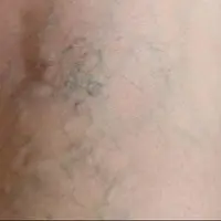 با چند عادت ساده از ابتلا به واریس پیشگیری کنیم