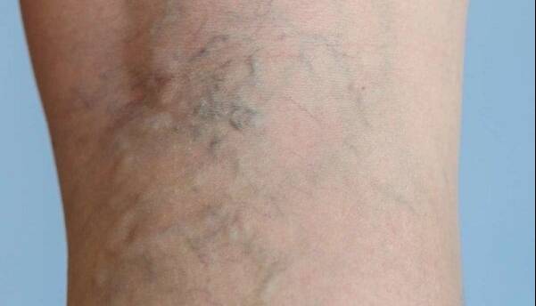 با چند عادت ساده از ابتلا به واریس پیشگیری کنیم