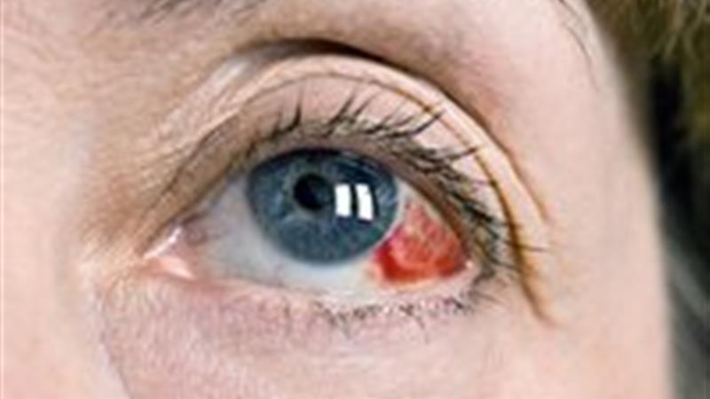 درمان های خانگی خونریزی زیر ملتحمه چشم