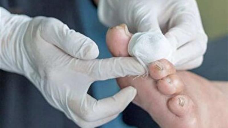 پیشگیری از بروز زخم پای دیابتی، همزمان با شیوع دیابت