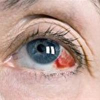 درمان های خانگی خونریزی زیر ملتحمه چشم