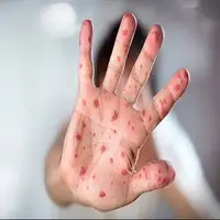 ایران در مرحله حذف سرخک و سرخجه / واکسیناسیون موثرترین راه کنترل بیماری‌های واگیر