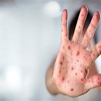 ایران در مرحله حذف سرخک و سرخجه / واکسیناسیون موثرترین راه کنترل بیماریهای واگیر