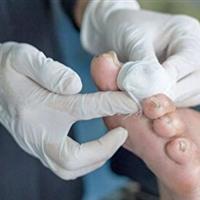 پیشگیری از بروز زخم پای دیابتی، همزمان با شیوع دیابت