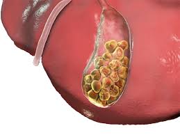 بهترین مسکن که درد سنگ کیسه صفرا را از بین میبرد