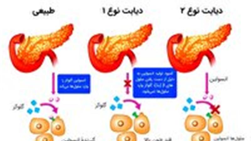 ابتلا به دیابت نوع ۲ در افراد کمتر از ۲۰ سال