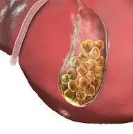 بهترین مسکن که درد سنگ کیسه صفرا را از بین میبرد