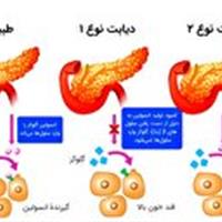 ابتلا به دیابت نوع ۲ در افراد کمتر از ۲۰ سال