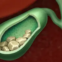 گیاهان مفید برای کیسه صفرا